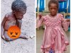 Remarkable Recovery for Malnourished Child Found Abandoned in Benue